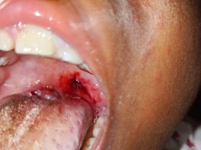 Kabare : La Société civile de Mudusa alerte sur la pratique illégale de la section de la luette chez les enfants